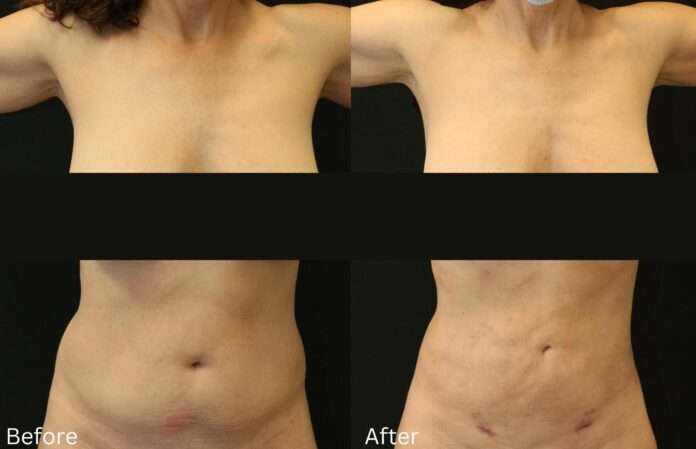 Gender Affirming Surgery